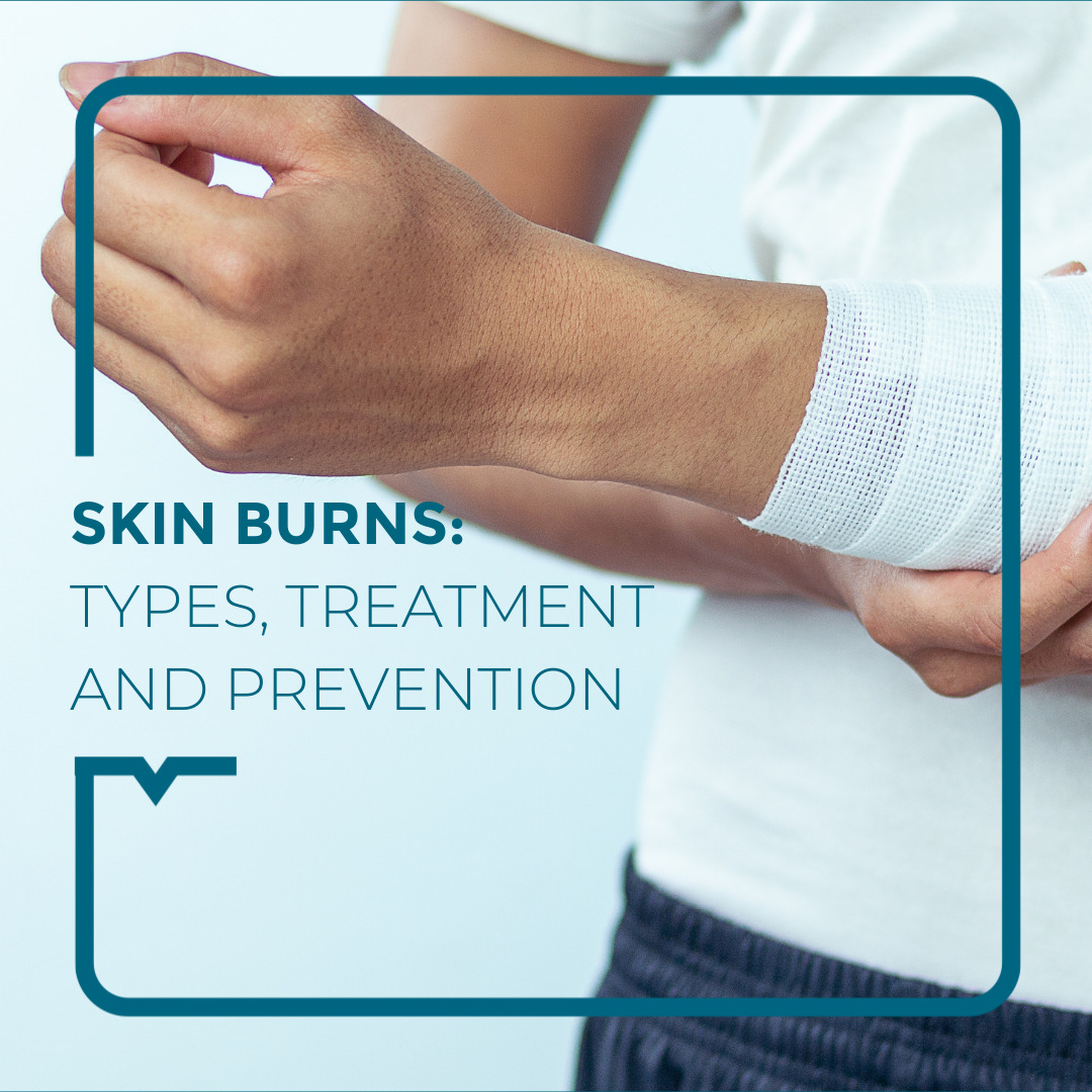 Thermal Burns Type Treatment And Prevention Alegria Medical Centre 4950