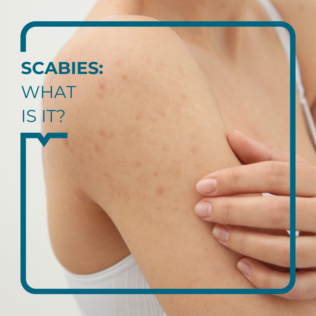 Scabies Symptoms Treatments And Prevention Alegria Medical Centre 0975